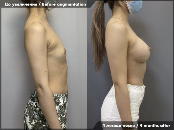 breast_augmentation_23