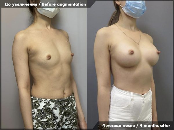 breast_augmentation_25
