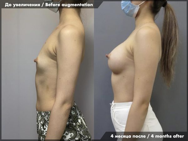 breast_augmentation_27