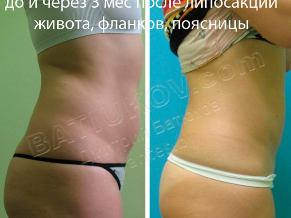 liposuction-10b