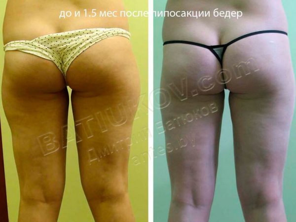 liposuction-15b