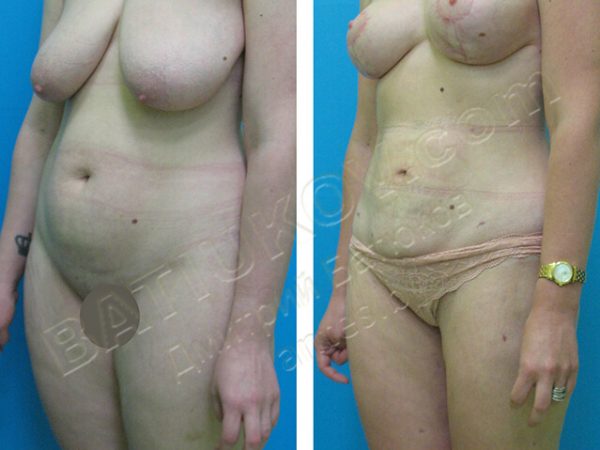 liposuction-1b