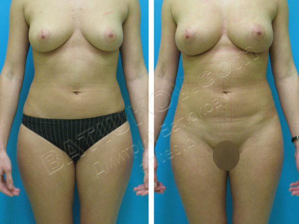 liposuction-21b
