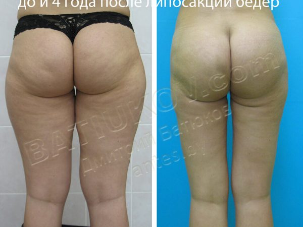 liposuction-23b