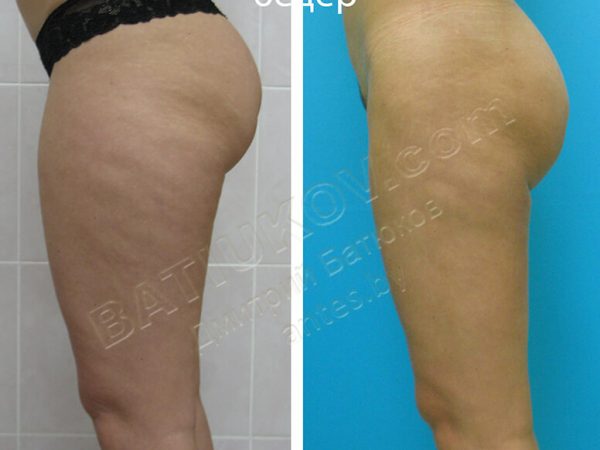 liposuction-25b
