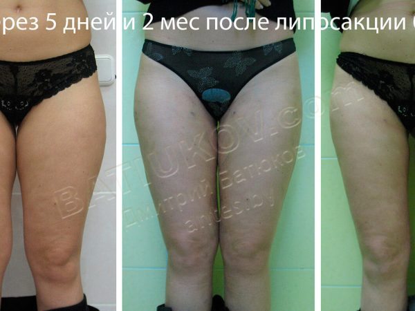 liposuction-27b