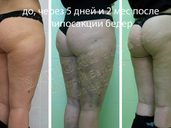 liposuction-30b