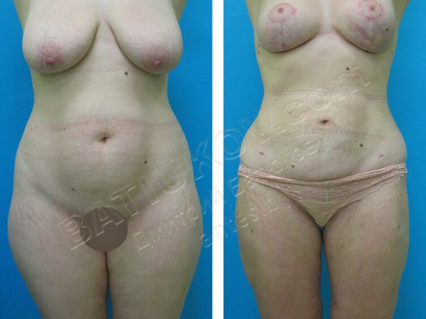 liposuction-3b