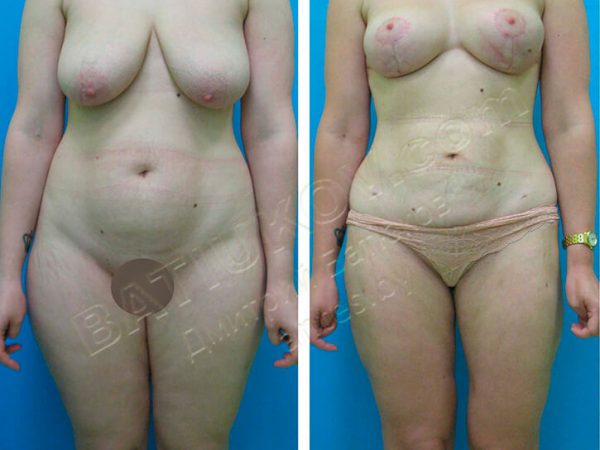 liposuction-4b