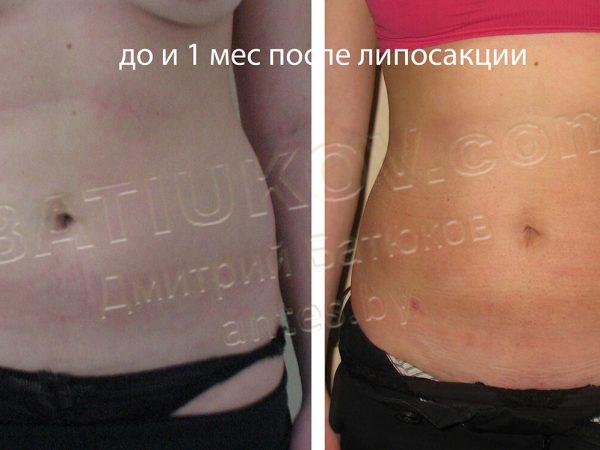 liposuction-5b