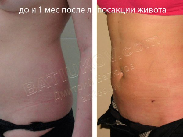liposuction-6b