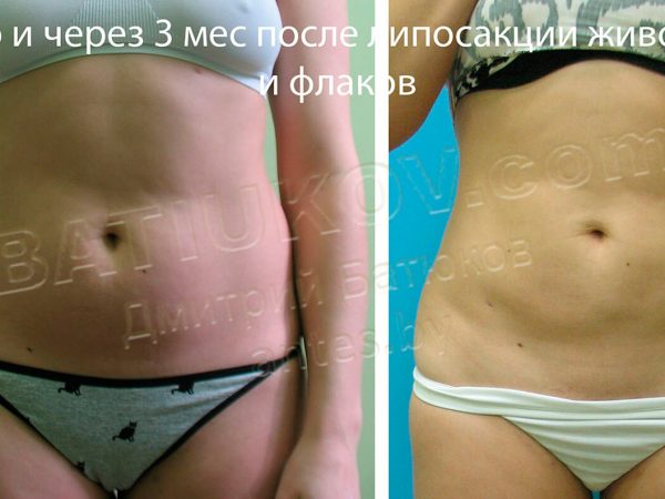 liposuction-8b