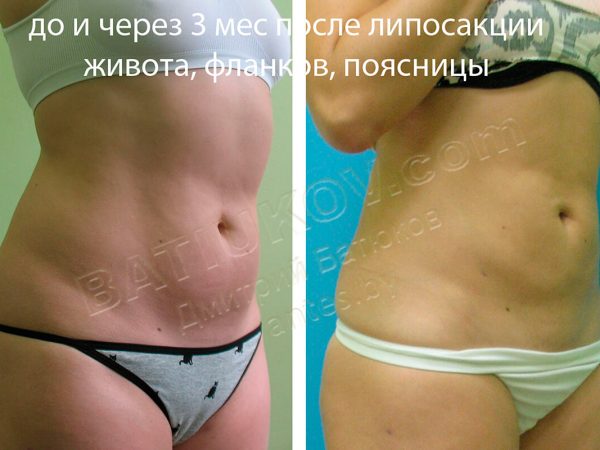 liposuction-9b